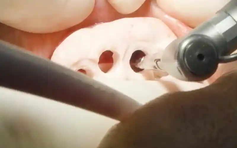 Implant và thiết bị cấy ghép